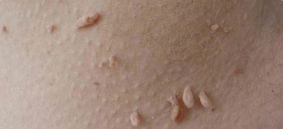 Metoda transmisji HPV