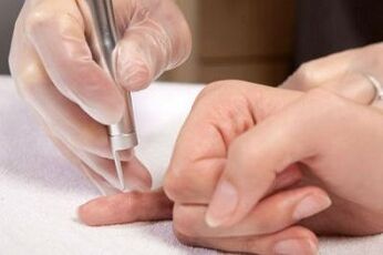 jak pozbyć się brodawczaków na ciele