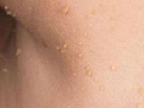 przyczyny pojawienia się brodawczaków na ciele